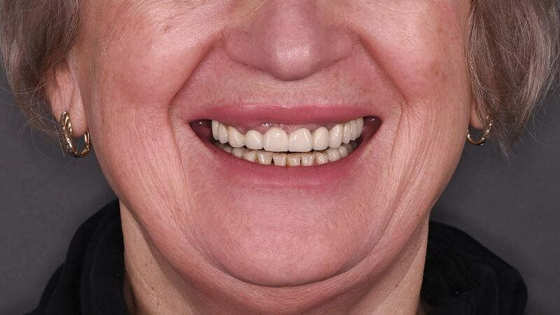 Zâmbet lateral stanga_înainte